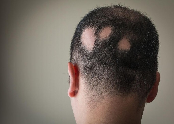 Alopecia: entenda a doença que afeta cabelos e autoestima