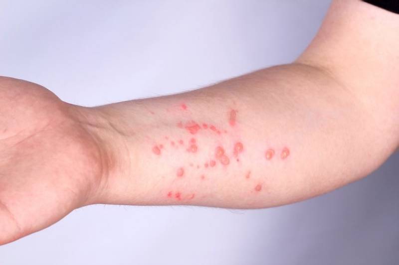 avisos de mpox sintomas