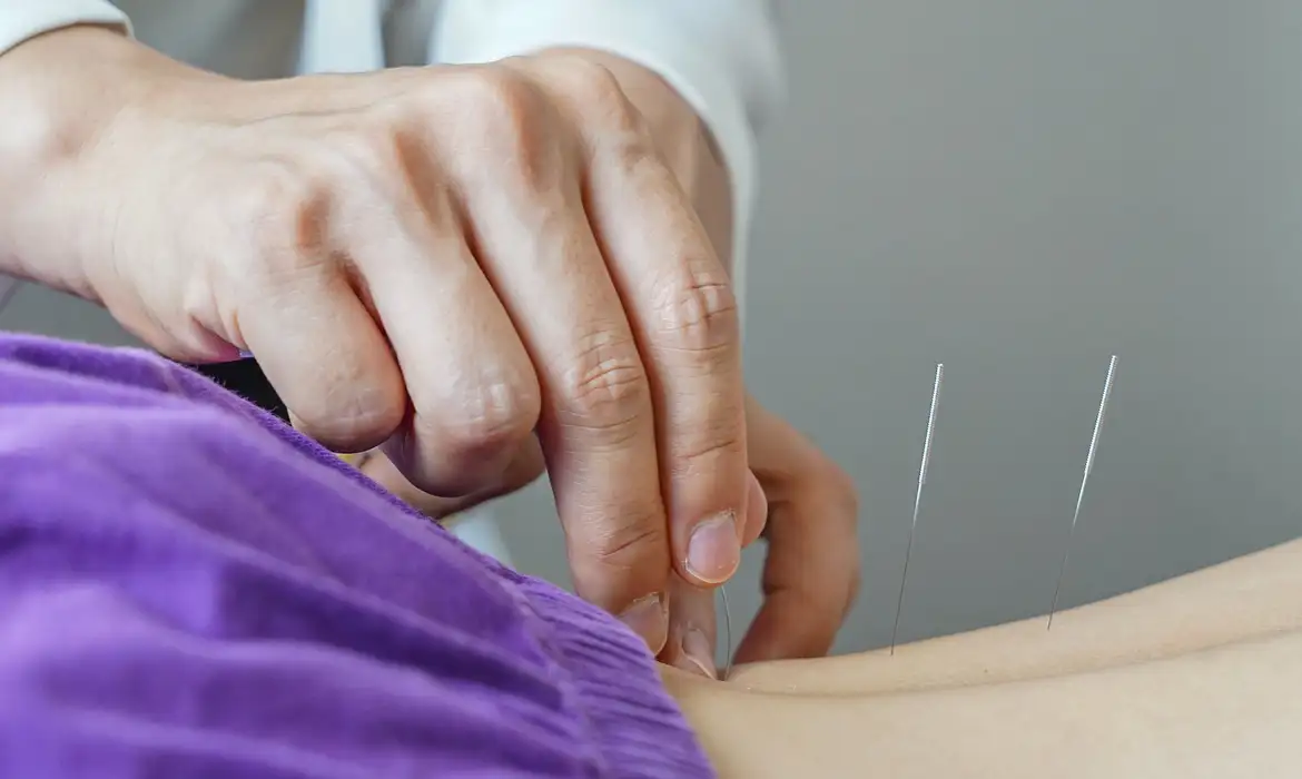 acupuntura
