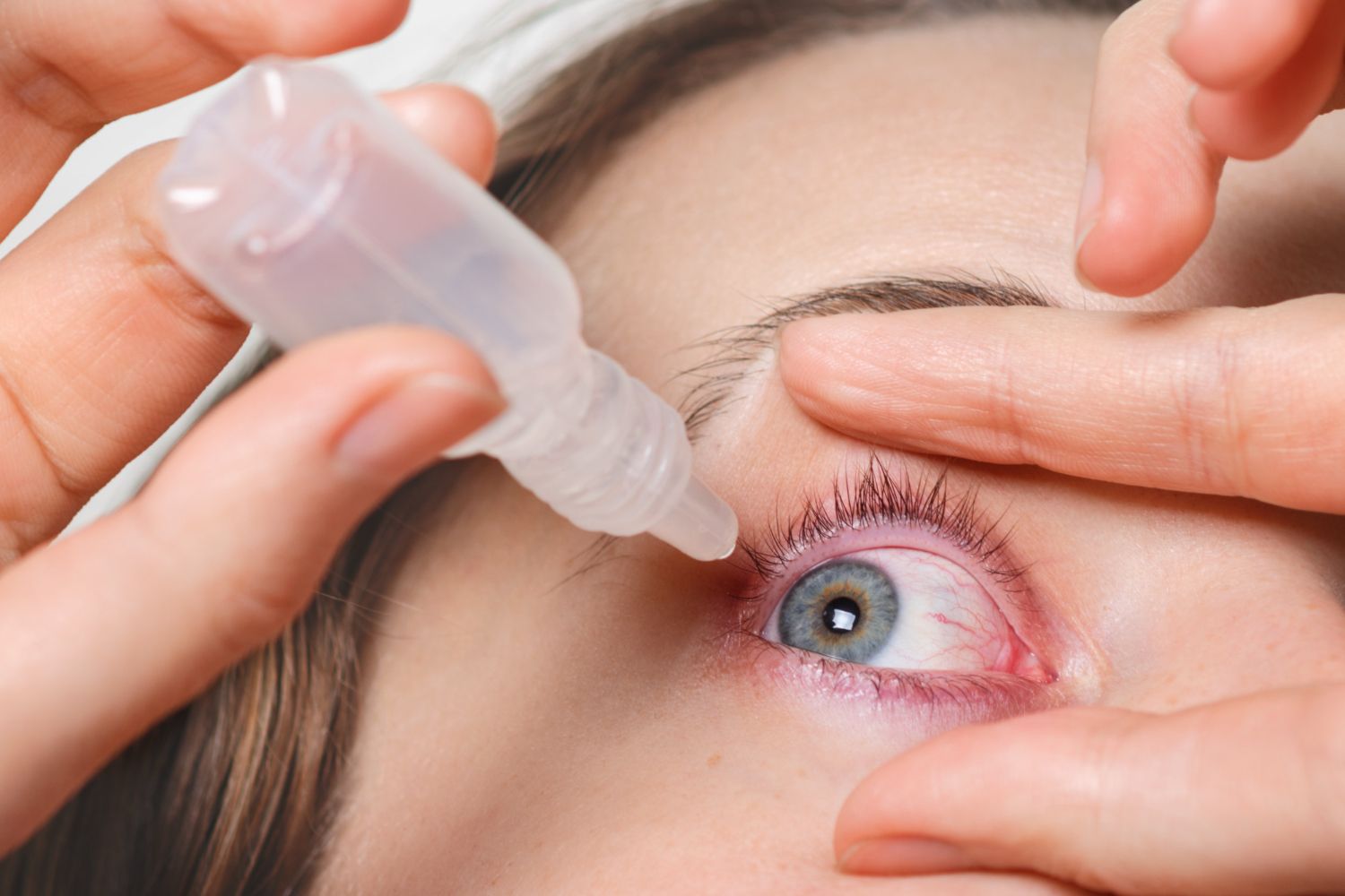 glaucoma