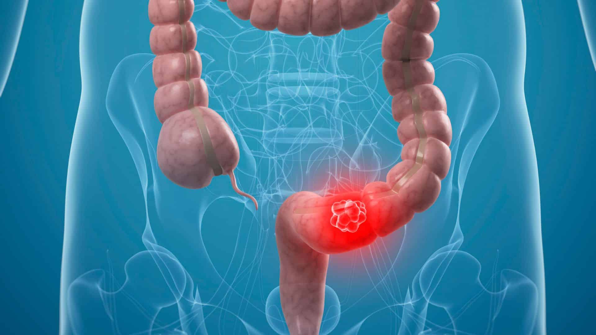 SUS passa a adotar novo exame para rastrear câncer de intestino no Brasil