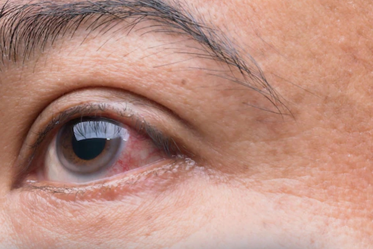 Glaucoma pode afetar mais de 1,7 milhão de brasileiros