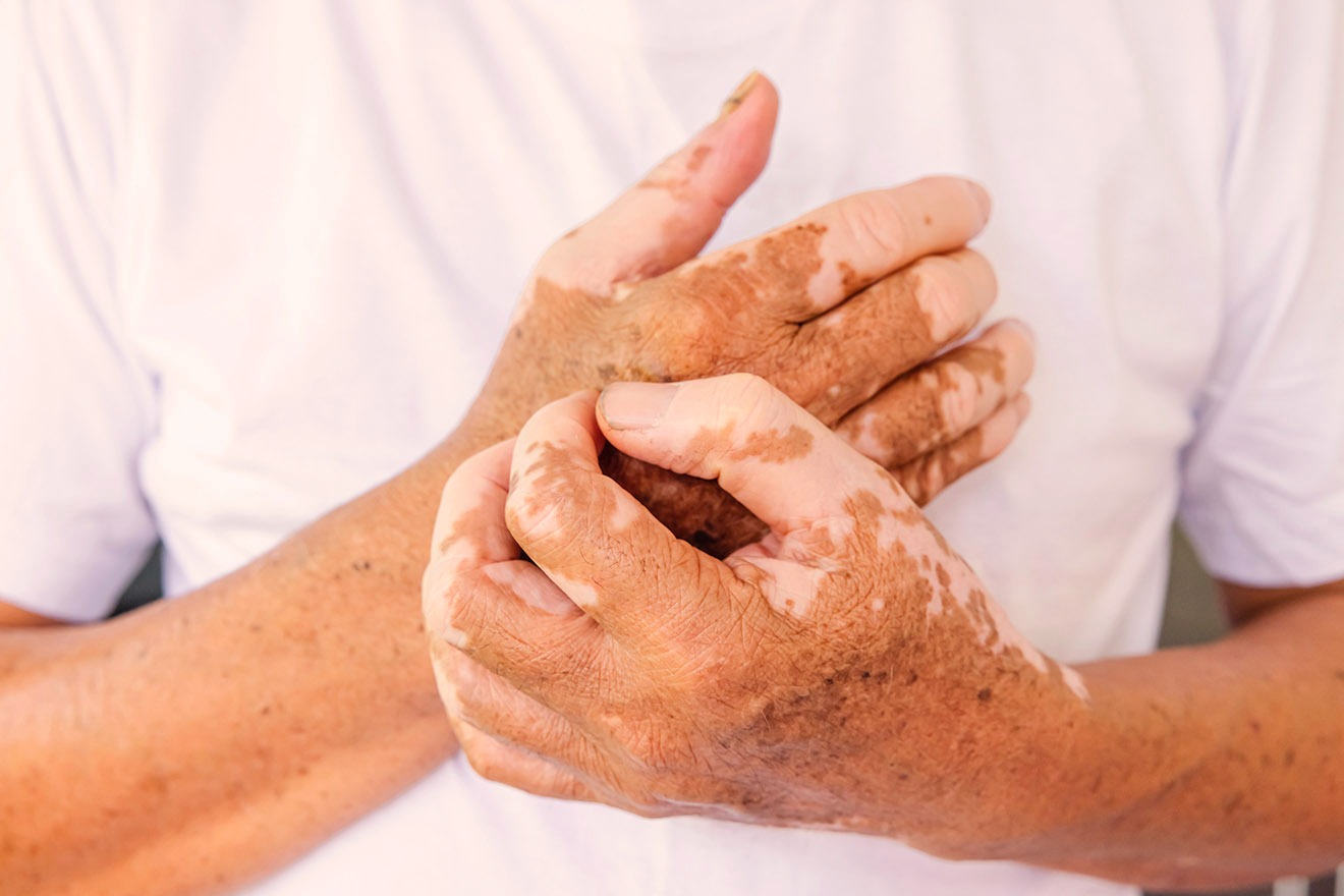 Vitiligo vai além da estética e pode comprometer a saúde mental de quem convive com a doença