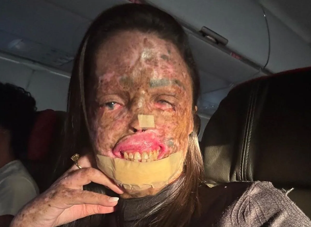 Xeroderma pigmentoso: saiba o que é a doença de influenciadora que morreu aos 37 anos